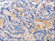 The image on the left is immunohistochemistry of paraffin-embedded Human thyroid cancer tissue using CSB-PA584015(CDK10 Antibody) at dilution 1/25, on the right is treated with fusion protein. (Original magnification: ×200)