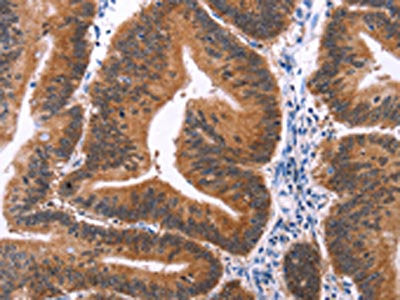 The image on the left is immunohistochemistry of paraffin-embedded Human colon cancer tissue using CSB-PA584061(MAPK13 Antibody) at dilution 1/15, on the right is treated with synthetic peptide. (Original magnification: ×200)