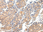The image on the left is immunohistochemistry of paraffin-embedded Human prostate cancer tissue using CSB-PA584071(MAP2 Antibody) at dilution 1/20, on the right is treated with fusion protein. (Original magnification: ×200)