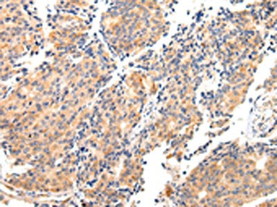 The image on the left is immunohistochemistry of paraffin-embedded Human prostate cancer tissue using CSB-PA584071(MAP2 Antibody) at dilution 1/20, on the right is treated with fusion protein. (Original magnification: ×200)