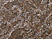 The image on the left is immunohistochemistry of paraffin-embedded Human liver cancer tissue using CSB-PA584245(GSTP1 Antibody) at dilution 1/60, on the right is treated with fusion protein. (Original magnification: ×200)