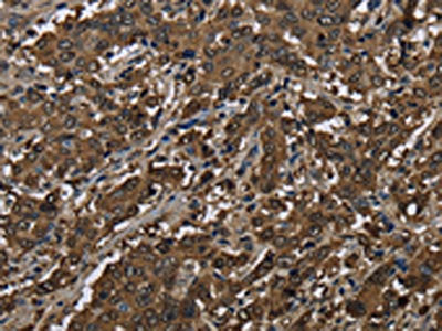 The image on the left is immunohistochemistry of paraffin-embedded Human liver cancer tissue using CSB-PA584245(GSTP1 Antibody) at dilution 1/60, on the right is treated with fusion protein. (Original magnification: ×200)