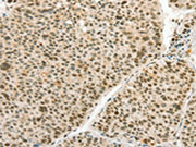 The image on the left is immunohistochemistry of paraffin-embedded Human liver cancer tissue using CSB-PA584378(ANGPT4 Antibody) at dilution 1/70, on the right is treated with synthetic peptide. (Original magnification: ×200)