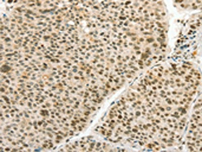 The image on the left is immunohistochemistry of paraffin-embedded Human liver cancer tissue using CSB-PA584378(ANGPT4 Antibody) at dilution 1/70, on the right is treated with synthetic peptide. (Original magnification: ×200)