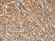 The image on the left is immunohistochemistry of paraffin-embedded Human gastic cancer tissue using CSB-PA584418(AIMP1 Antibody) at dilution 1/40, on the right is treated with synthetic peptide. (Original magnification: ×200)