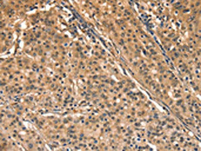 The image on the left is immunohistochemistry of paraffin-embedded Human gastic cancer tissue using CSB-PA584418(AIMP1 Antibody) at dilution 1/40, on the right is treated with synthetic peptide. (Original magnification: ×200)
