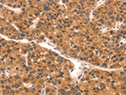 The image on the left is immunohistochemistry of paraffin-embedded Human liver cancer tissue using CSB-PA584449(EPPIN Antibody) at dilution 1/25, on the right is treated with synthetic peptide. (Original magnification: ×200)