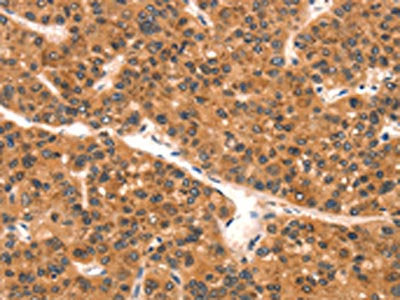 The image on the left is immunohistochemistry of paraffin-embedded Human liver cancer tissue using CSB-PA584449(EPPIN Antibody) at dilution 1/25, on the right is treated with synthetic peptide. (Original magnification: ×200)