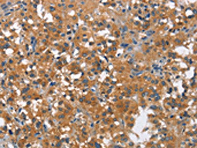 The image on the left is immunohistochemistry of paraffin-embedded Human thyroid cancer tissue using CSB-PA584549(COX5A Antibody) at dilution 1/25, on the right is treated with synthetic peptide. (Original magnification: ×200)
