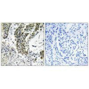 Immunohistochemistry analysis of paraffin-embedded human lung carcinoma tissue using RREB1 antibody.