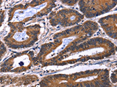 The image on the left is immunohistochemistry of paraffin-embedded Human colon cancer tissue using CSB-PA584603(IL1A Antibody) at dilution 1/60, on the right is treated with fusion protein. (Original magnification: ×200)