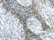 The image on the left is immunohistochemistry of paraffin-embedded Human esophagus cancer tissue using CSB-PA584727(CHRDL1 Antibody) at dilution 1/35, on the right is treated with synthetic peptide. (Original magnification: ×200)