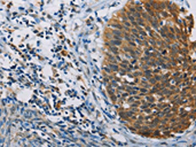 The image on the left is immunohistochemistry of paraffin-embedded Human tonsil tissue using CSB-PA584842(FXYD1 Antibody) at dilution 1/60, on the right is treated with fusion protein. (Original magnification: ×200)