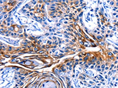 The image on the left is immunohistochemistry of paraffin-embedded Human esophagus cancer tissue using CSB-PA584850(CLCA4 Antibody) at dilution 1/15, on the right is treated with fusion protein. (Original magnification: ×200)