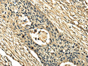 The image on the left is immunohistochemistry of paraffin-embedded Human esophagus cancer tissue using CSB-PA585085(TSSC1 Antibody) at dilution 1/25, on the right is treated with fusion protein. (Original magnification: ×200)