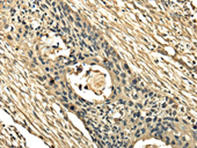 The image on the left is immunohistochemistry of paraffin-embedded Human esophagus cancer tissue using CSB-PA585085(TSSC1 Antibody) at dilution 1/25, on the right is treated with fusion protein. (Original magnification: ×200)