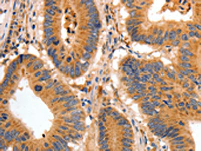 The image on the left is immunohistochemistry of paraffin-embedded Human colon cancer tissue using CSB-PA585175(BAIAP2 Antibody) at dilution 1/30, on the right is treated with fusion protein. (Original magnification: ×200)