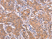 The image on the left is immunohistochemistry of paraffin-embedded Human gastic cancer tissue using CSB-PA585322(ETFB Antibody) at dilution 1/25, on the right is treated with synthetic peptide. (Original magnification: ×200)