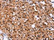 The image on the left is immunohistochemistry of paraffin-embedded Human thyroid cancer tissue using CSB-PA585463(GPR124 Antibody) at dilution 1/40, on the right is treated with synthetic peptide. (Original magnification: ×200)
