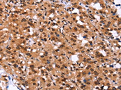 The image on the left is immunohistochemistry of paraffin-embedded Human thyroid cancer tissue using CSB-PA585463(GPR124 Antibody) at dilution 1/40, on the right is treated with synthetic peptide. (Original magnification: ×200)