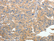 The image on the left is immunohistochemistry of paraffin-embedded Human ovarian cancer tissue using CSB-PA585649(TERT Antibody) at dilution 1/50, on the right is treated with synthetic peptide. (Original magnification: ×200)