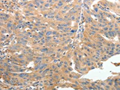 The image on the left is immunohistochemistry of paraffin-embedded Human ovarian cancer tissue using CSB-PA585649(TERT Antibody) at dilution 1/50, on the right is treated with synthetic peptide. (Original magnification: ×200)