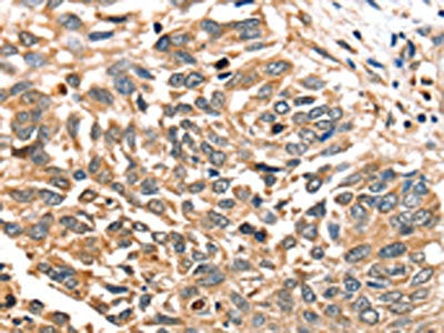 The image on the left is immunohistochemistry of paraffin-embedded Human liver cancer tissue using CSB-PA585733(SLC16A12 Antibody) at dilution 1/30, on the right is treated with synthetic peptide. (Original magnification: ×200)