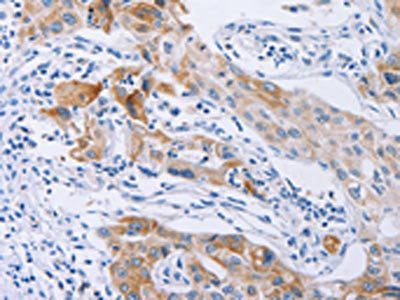 The image on the left is immunohistochemistry of paraffin-embedded Human lung cancer tissue using CSB-PA585818(CDC27 Antibody) at dilution 1/40, on the right is treated with synthetic peptide. (Original magnification: ×200)