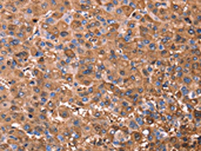 The image on the left is immunohistochemistry of paraffin-embedded Human liver cancer tissue using CSB-PA585877(ERN2 Antibody) at dilution 1/40, on the right is treated with synthetic peptide. (Original magnification: ×200)