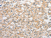 The image on the left is immunohistochemistry of paraffin-embedded Human thyroid cancer tissue using CSB-PA585936(TLR4 Antibody) at dilution 1/50, on the right is treated with fusion protein. (Original magnification: ×200)