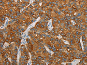 The image on the left is immunohistochemistry of paraffin-embedded Human liver cancer tissue using CSB-PA585956(FOSB Antibody) at dilution 1/20, on the right is treated with synthetic peptide. (Original magnification: ×200)