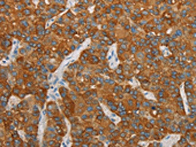 The image on the left is immunohistochemistry of paraffin-embedded Human liver cancer tissue using CSB-PA585956(FOSB Antibody) at dilution 1/20, on the right is treated with synthetic peptide. (Original magnification: ×200)