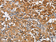 The image on the left is immunohistochemistry of paraffin-embedded Human thyroid cancer tissue using CSB-PA586126(ATP1B2 Antibody) at dilution 1/30, on the right is treated with fusion protein. (Original magnification: ×200)