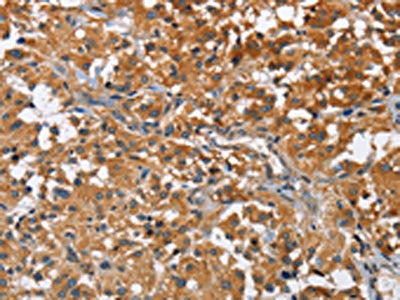 The image on the left is immunohistochemistry of paraffin-embedded Human thyroid cancer tissue using CSB-PA586126(ATP1B2 Antibody) at dilution 1/30, on the right is treated with fusion protein. (Original magnification: ×200)