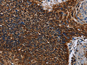 The image on the left is immunohistochemistry of paraffin-embedded Human cervical cancer tissue using CSB-PA586287(IDH2 Antibody) at dilution 1/60, on the right is treated with fusion protein. (Original magnification: ×200)
