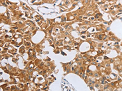 The image on the left is immunohistochemistry of paraffin-embedded Human lung cancer tissue using CSB-PA586381(MUC20 Antibody) at dilution 1/40, on the right is treated with fusion protein. (Original magnification: ×200)