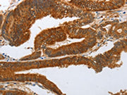 The image on the left is immunohistochemistry of paraffin-embedded Human colon cancer tissue using CSB-PA586591(NOTCH3 Antibody) at dilution 1/25, on the right is treated with synthetic peptide. (Original magnification: ×200)