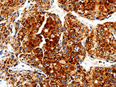 The image is immunohistochemistry of paraffin-embedded Human liver cancer tissue using CSB-PA586799(COX19 Antibody) at dilution 1/50. (Original magnification: ×200)