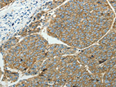 The image on the left is immunohistochemistry of paraffin-embedded Human liver cancer tissue using CSB-PA587029(SLC16A1 Antibody) at dilution 1/50, on the right is treated with synthetic peptide. (Original magnification: ×200)