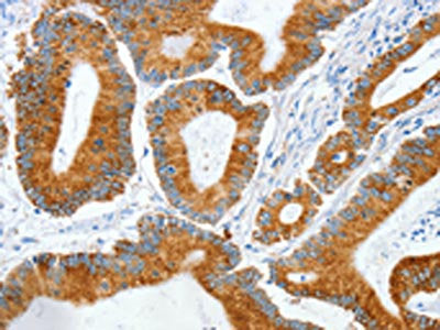 The image on the left is immunohistochemistry of paraffin-embedded Human colon cancer tissue using CSB-PA587080(MANF Antibody) at dilution 1/50, on the right is treated with synthetic peptide. (Original magnification: X200)