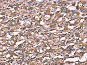 The image on the left is immunohistochemistry of paraffin-embedded Human thyroid cancer tissue using CSB-PA587093(SPAST Antibody) at dilution 1/40, on the right is treated with synthetic peptide. (Original magnification: ×200)
