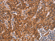 The image on the left is immunohistochemistry of paraffin-embedded Human gastic cancer tissue using CSB-PA587164(GNAT3 Antibody) at dilution 1/15, on the right is treated with synthetic peptide. (Original magnification: ×200)