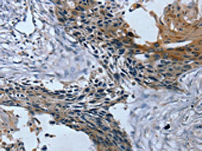 The image on the left is immunohistochemistry of paraffin-embedded Human esophagus cancer tissue using CSB-PA587272(TRIM31 Antibody) at dilution 1/20, on the right is treated with fusion protein. (Original magnification: ×200)