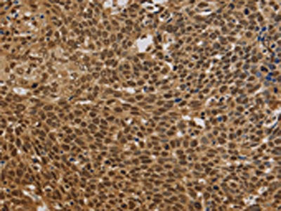 The image on the left is immunohistochemistry of paraffin-embedded Human cervical cancer tissue using CSB-PA587286(BRAF Antibody) at dilution 1/30, on the right is treated with synthetic peptide. (Original magnification: ×200)