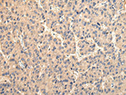 The image on the left is immunohistochemistry of paraffin-embedded Human liver cancer tissue using CSB-PA587313(USP15 Antibody) at dilution 1/35, on the right is treated with fusion protein. (Original magnification: ×200)