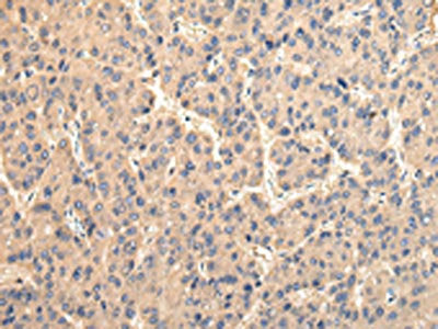 The image on the left is immunohistochemistry of paraffin-embedded Human liver cancer tissue using CSB-PA587313(USP15 Antibody) at dilution 1/35, on the right is treated with fusion protein. (Original magnification: ×200)