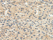 The image on the left is immunohistochemistry of paraffin-embedded Human liver cancer tissue using CSB-PA587496(CHRNA1 Antibody) at dilution 1/20, on the right is treated with synthetic peptide. (Original magnification: ×200)