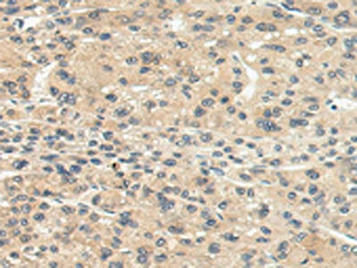 The image on the left is immunohistochemistry of paraffin-embedded Human liver cancer tissue using CSB-PA587496(CHRNA1 Antibody) at dilution 1/20, on the right is treated with synthetic peptide. (Original magnification: ×200)