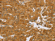 The image on the left is immunohistochemistry of paraffin-embedded Human liver cancer tissue using CSB-PA587516(TNFSF13 Antibody) at dilution 1/40, on the right is treated with synthetic peptide. (Original magnification: ×200)