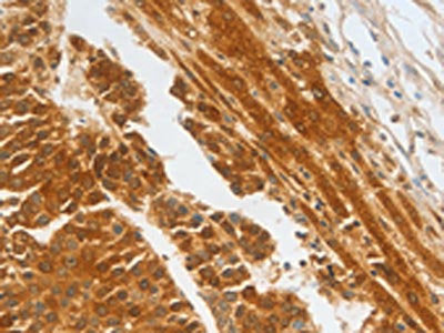 The image on the left is immunohistochemistry of paraffin-embedded Human liver cancer tissue using CSB-PA587680(CFHR1 Antibody) at dilution 1/30, on the right is treated with fusion protein. (Original magnification: ×200)